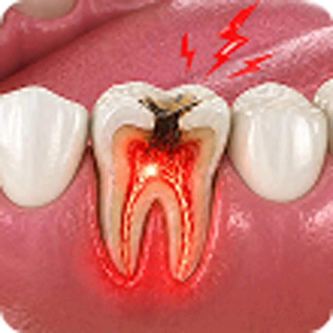Tooth extraction