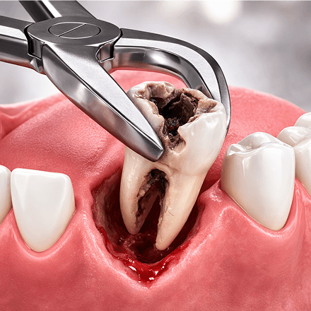 Tooth Extractions Icon